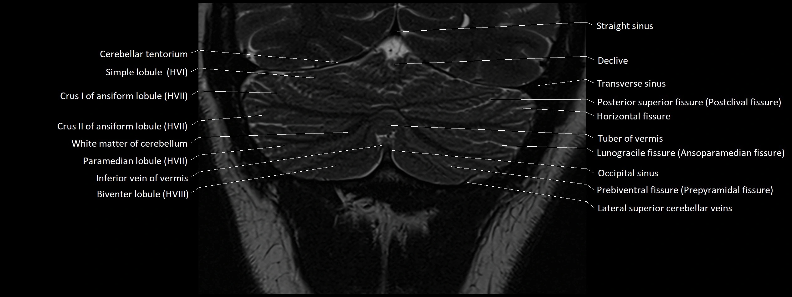 Anatomy of cerebellum coronal cross sectional 3T image 23.webp